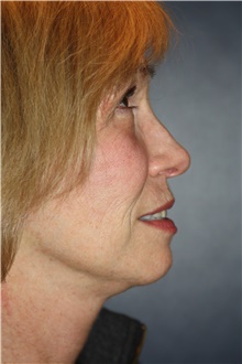 Facelift After Photo by Larry Weinstein, MD; Chester, NJ - Case 45840