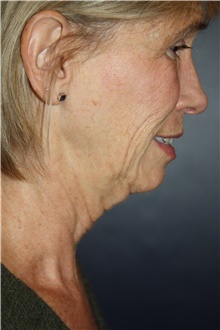 Facelift Before Photo by Larry Weinstein, MD; Chester, NJ - Case 45840