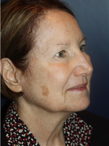 Facelift Before Photo by Larry Weinstein, MD; Chester, NJ - Case 46048