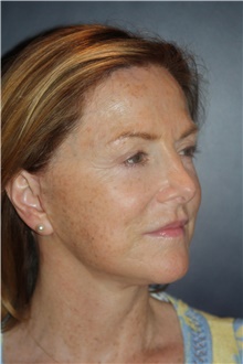 Facelift After Photo by Larry Weinstein, MD; Chester, NJ - Case 46049