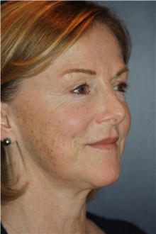 Facelift Before Photo by Larry Weinstein, MD; Chester, NJ - Case 46049