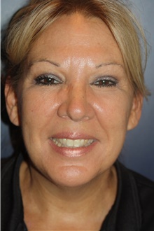 Facelift After Photo by Larry Weinstein, MD; Chester, NJ - Case 46050