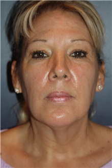 Facelift Before Photo by Larry Weinstein, MD; Chester, NJ - Case 46050