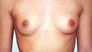 Breast Augmentation Before Photo by Larry Weinstein, MD; Chester, NJ - Case 6960