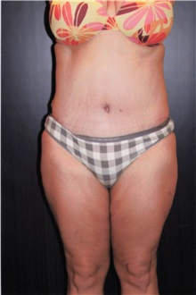 Tummy Tuck After Photo by Larry Weinstein, MD; Chester, NJ - Case 50331