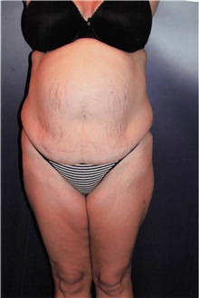 Tummy Tuck Before Photo by Larry Weinstein, MD; Chester, NJ - Case 50331