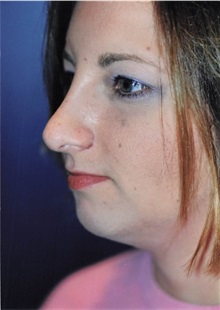 Rhinoplasty After Photo by Larry Weinstein, MD; Chester, NJ - Case 50330