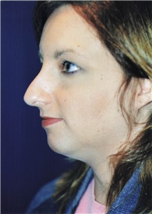 Rhinoplasty Before Photo by Larry Weinstein, MD; Chester, NJ - Case 50330