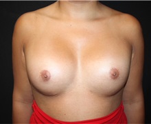 Breast Augmentation After Photo by Burt Greenberg, MD; Great Neck,  - Case 32779