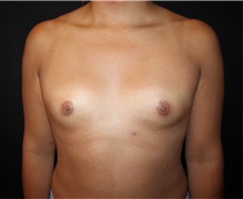 Breast Augmentation Before Photo by Burt Greenberg, MD; Great Neck,  - Case 32779