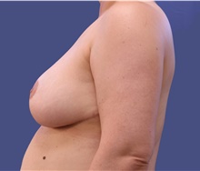 Breast Reduction After Photo by Lisa Jewell, MD, FACS; Torrance, CA - Case 47500