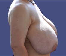 Breast Reduction Before Photo by Lisa Jewell, MD, FACS; Torrance, CA - Case 47500