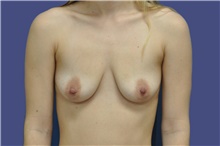 Breast Augmentation Before Photo by Lisa Jewell, MD; Torrance, CA - Case 47501