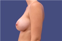 Breast Augmentation After Photo by Lisa Jewell, MD, FACS; Torrance, CA - Case 47501