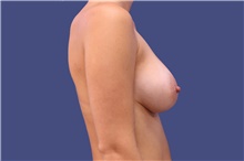 Breast Augmentation After Photo by Lisa Jewell, MD, FACS; Torrance, CA - Case 47501