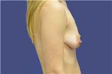 Breast Augmentation Before Photo by Lisa Jewell, MD, FACS; Torrance, CA - Case 47501