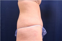 Tummy Tuck After Photo by Lisa Jewell, MD, FACS; Torrance, CA - Case 47502