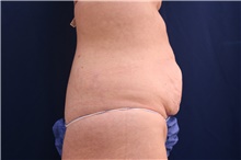 Tummy Tuck Before Photo by Lisa Jewell, MD, FACS; Torrance, CA - Case 47502
