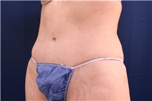 Tummy Tuck After Photo by Lisa Jewell, MD, FACS; Torrance, CA - Case 47502