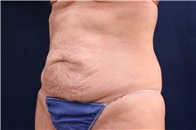Tummy Tuck Before Photo by Lisa Jewell, MD, FACS; Torrance, CA - Case 47502