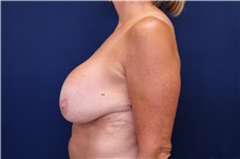 Breast Implant Removal Before Photo by Lisa Jewell, MD, FACS; Torrance, CA - Case 47505