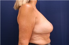 Breast Implant Removal After Photo by Lisa Jewell, MD, FACS; Torrance, CA - Case 47505
