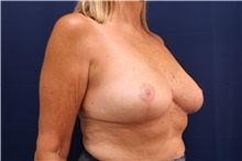 Breast Implant Removal After Photo by Lisa Jewell, MD, FACS; Torrance, CA - Case 47505