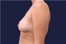 Breast Augmentation Before Photo by Lisa Jewell, MD, FACS; Torrance, CA - Case 47774