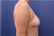 Breast Augmentation Before Photo by Lisa Jewell, MD, FACS; Torrance, CA - Case 47774