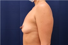 Breast Augmentation Before Photo by Lisa Jewell, MD, FACS; Torrance, CA - Case 47781