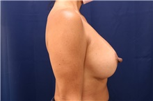 Breast Augmentation After Photo by Lisa Jewell, MD, FACS; Torrance, CA - Case 47781