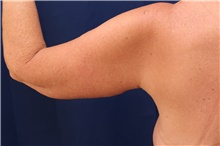 Arm Lift After Photo by Lisa Jewell, MD, FACS; Torrance, CA - Case 47810