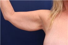 Arm Lift Before Photo by Lisa Jewell, MD, FACS; Torrance, CA - Case 47810