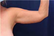 Arm Lift After Photo by Lisa Jewell, MD, FACS; Torrance, CA - Case 47810