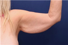 Arm Lift Before Photo by Lisa Jewell, MD, FACS; Torrance, CA - Case 47810