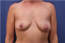 Breast Augmentation Before Photo by Lisa Jewell, MD, FACS; Torrance, CA - Case 47833