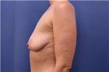 Breast Augmentation Before Photo by Lisa Jewell, MD, FACS; Torrance, CA - Case 47833