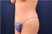 Tummy Tuck After Photo by Lisa Jewell, MD, FACS; Torrance, CA - Case 48277