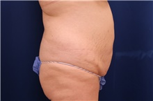 Tummy Tuck Before Photo by Lisa Jewell, MD, FACS; Torrance, CA - Case 48277