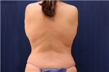 Tummy Tuck After Photo by Lisa Jewell, MD, FACS; Torrance, CA - Case 48277