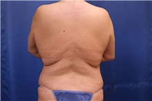 Tummy Tuck Before Photo by Lisa Jewell, MD, FACS; Torrance, CA - Case 48277