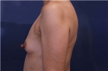 Breast Augmentation Before Photo by Lisa Jewell, MD, FACS; Torrance, CA - Case 48385