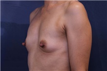 Breast Augmentation Before Photo by Lisa Jewell, MD, FACS; Torrance, CA - Case 48385
