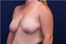 Breast Lift Before Photo by Lisa Jewell, MD, FACS; Torrance, CA - Case 48387