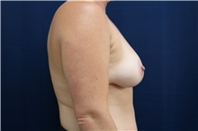 Breast Lift After Photo by Lisa Jewell, MD, FACS; Torrance, CA - Case 48387