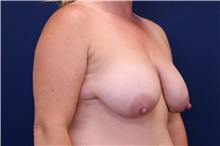 Breast Lift Before Photo by Lisa Jewell, MD, FACS; Torrance, CA - Case 48387