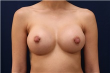 Breast Augmentation After Photo by Lisa Jewell, MD, FACS; Torrance, CA - Case 48444