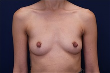 Breast Augmentation Before Photo by Lisa Jewell, MD, FACS; Torrance, CA - Case 48444