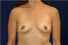 Breast Augmentation Before Photo by Lisa Jewell, MD, FACS; Torrance, CA - Case 49209