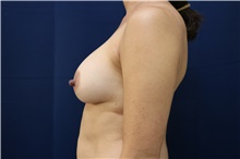 Breast Augmentation After Photo by Lisa Jewell, MD, FACS; Torrance, CA - Case 49209